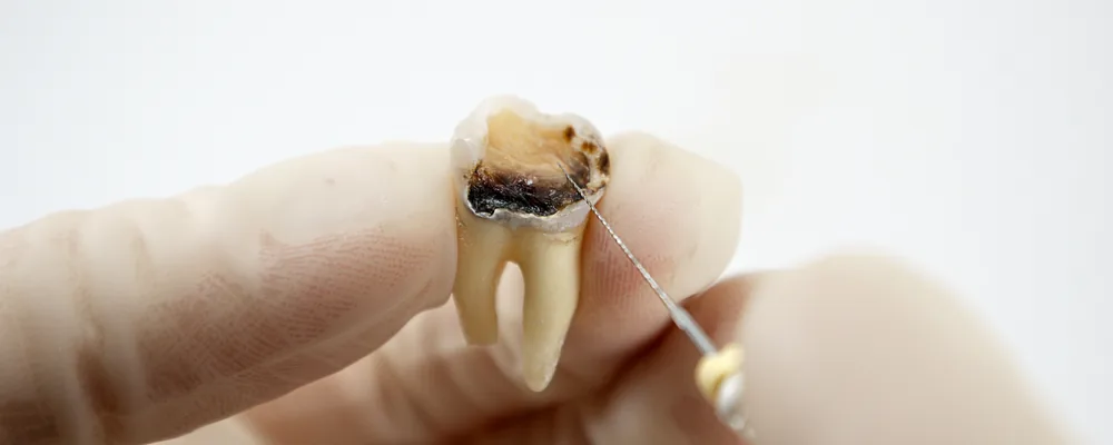 虫歯が進行して抜いた歯の断面と歯科用の器具｜獨協大学前シティデンタルクリニック トーブイコート