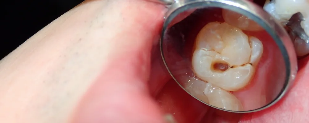 口腔内ミラーに映る奥歯の噛む面と溝の状態｜獨協大学前シティデンタルクリニック トーブイコート