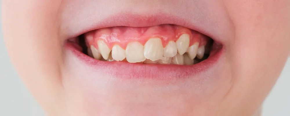 床矯正を検討する時期のお子さんの歯並びのイメージ｜獨協大学前シティデンタルクリニック トーブイコート