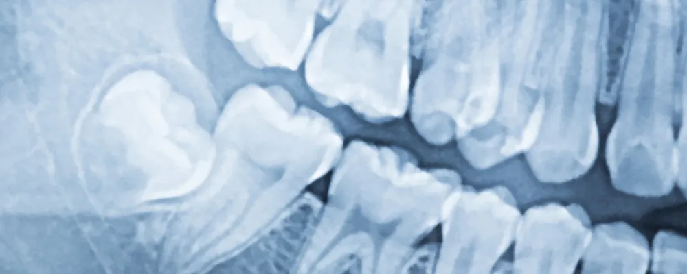 手前の歯に向かって傾いた親知らずのレントゲン画像｜獨協大学前シティデンタルクリニック